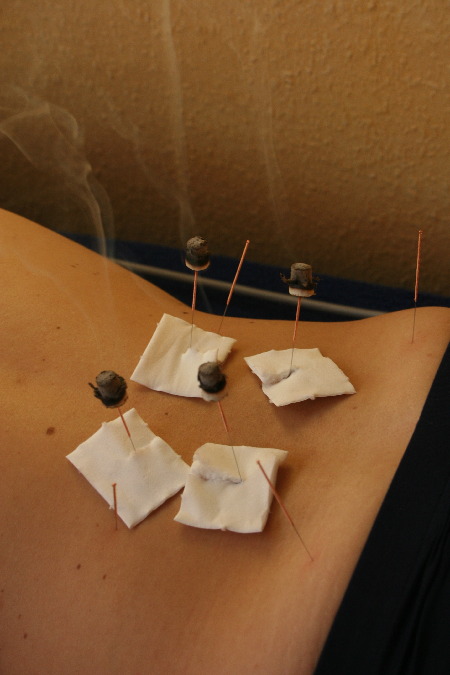 Akupunktur und Moxibustion